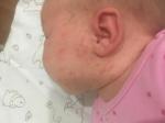 Высыпание на лице у новорождённого фото 2