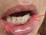 На слизистой нижней губы вытянутое пульсирующеся образование фото 4