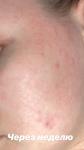 Как бороться с аллергией на лице? фото 4