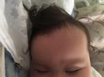 Шишка на голове у ребенка 8 месяцев без симптомов фото 2