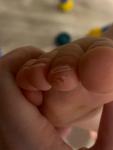 Образование на пальце ноги к ребёнка фото 1