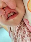 Откололся передний зуб у ребенка фото 1