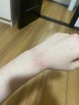Сухой участок на руке, как аллергия фото 1