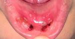 Воспаление полости рта и ссыпь по телу фото 2