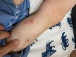 Фиолетовые пятна от укуса комара у ребенка фото 1