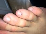 Пятно на ногте пальца ноги меланома или гематома? фото 2