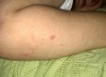 Аллергия у ребёнка не проходит фото 3