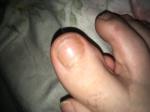 Грибок ногтей на пальце ноги фото 4