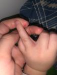 Мелкая сыпь на ручках у ребёнка 2 года фото 1