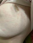 Пятна на груди девочка 15 лет фото 2