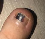 Чёрное пятно на ногте после травмы фото 1