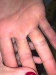 Разрастания на пальцах и губе фото 1