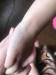 Высыпания у ребенка на пальцах рук, бедре фото 1