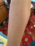 Сыпь на ногах, была аллергия, иногда чешется фото 1