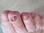 Грибковые наросты на ногтях фото 2