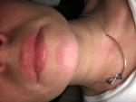 Воспаленные губы фото 1