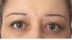 Периодические кровоизлияние в глаз фото 1