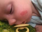 Красное пятно на щечке у ребёнка 3 месяца. Подскажите что делать фото 1