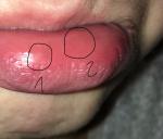 Что со слизистой нижней губы? фото 1