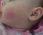 Красное пятно на щеке у ребенка фото 1