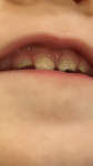 Подскажите пожалуйста, что это такое с зубами? фото 2