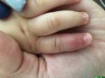 Опухает и краснеет пальчик на руке у ребёнка фото 1
