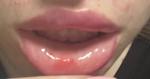 Красные пятна на внутренней стороне губ фото 2