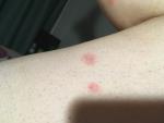 Появление красных пятен после укусов комаров фото 1