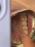Степень поражения зуба фото 1