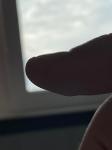 Чёрная точка под ногтем, и кровоизлияние на пальце фото 5