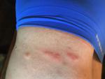 Высыпания в виде укусов комаров на талии, голенях и предплечиях фото 3