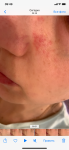 Сыпь на лице в виде белых прыщиков с покраснением фото 3