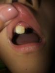 Зуб с желтыми пятнами фото 1