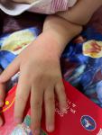 Покраснения на поверхности рук у ребенка 1 год и 11 месяцев фото 3