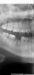 Удаление зуба не опасно фото 1