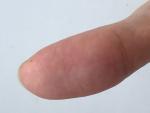 Проблемы с кожей пальцев из за частого воздействия со спиртом фото 2
