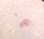 Пятно выпуклое жжение фото 1