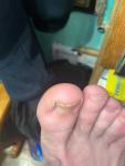 Утолщение ногтя пальца на ноге фото 2