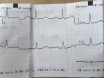 Боли В области сердца, кардиограмма фото 1