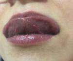 Воспаление под языком и образование на губе фото 2