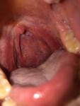 Шишки в горле, тонзиллит, увеличены лимфоузлы фото 2
