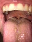 Увеличенные лимфоузлы, боль в горле, сыпь фото 4