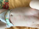 Красные пятна на теле у ребёнка 7 месяцев фото 3