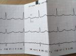 Боли В области сердца, кардиограмма фото 2