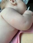 Сыпь у грудного ребёнка фото 1