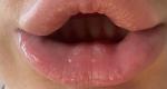 Уплотнения на нижней губы, как шишки фото 1