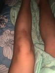 Травма коленного сустава/ушиб фото 3