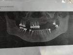 Можно ли обойтись без наращивания кости при установке 5 зубных имплантов фото 1