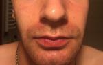 Пятна на лице вокруг: рта, носа, бровей и на лбу фото 1
