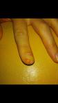 Нагноение пальца после срезания ногтя фото 1